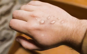 Việt Nam ghi nhận ca đậu mùa khỉ đầu tiên ở TP.HCM