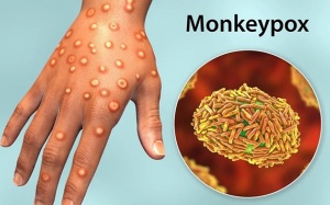 Việt Nam xuất hiện ca bệnh đậu mùa khỉ đầu tiên, Bộ Y tế chỉ đạo khẩn