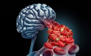 Xơ vữa động mạch ở người thiểu năng tuần hoàn não