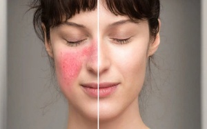 Nhận biết dấu hiệu ngoài da của bệnh lupus ban đỏ giai đoạn đầu