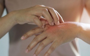 Các biện pháp khắc phục lupus ban đỏ hiệu quả 