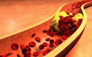 Mỡ máu cao và biến chứng nguy hiểm khi bị xơ vữa động mạch