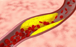 Xơ vữa động mạch ở người mỡ máu cao nguy hiểm thế nào?