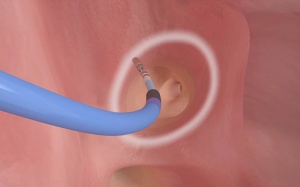 Bị ngoại tâm thu, khi nào cần can thiệp đốt điện tim?