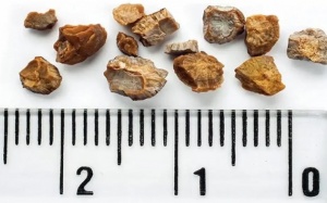 Sỏi mật 8mm có nguy hiểm không?