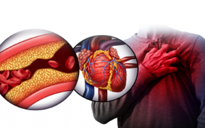 Cách phòng ngừa rối loạn lipid máu, ngăn biến chứng tim mạch