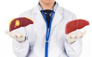  Gan nhiễm mỡ độ 1 có nguy hiểm không? Cách điều trị hiệu quả