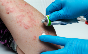 Biện pháp chăm sóc tại nhà giúp cải thiện bệnh vảy nến 