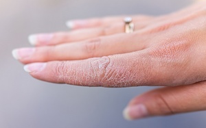 5 cách phòng ngừa khô da ngày lạnh