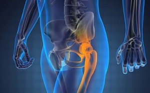 Khí ozone có thể giúp tôi khỏi cần phẫu thuật khớp háng không?