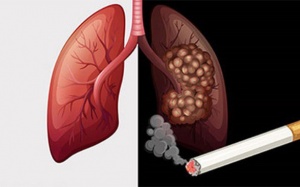 4 lầm tưởng về ung thư phổi bạn cần biết