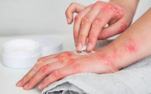 Sai lầm tai hại khi chăm sóc da vảy nến