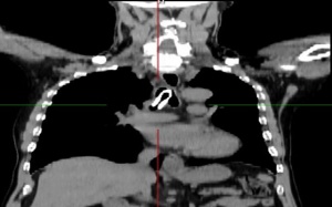 Bệnh viện Bạch Mai: Gắp thành công dị vật hiếm gặp trong đường thở của bệnh nhân