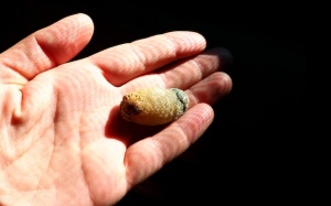 Sỏi mật 38mm có cần phải mổ không?