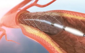 Ưu điểm và những lưu ý khi đặt stent động mạch vành