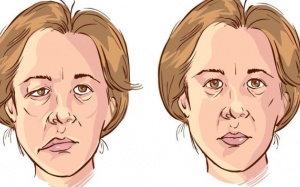 Cẩn trọng với bệnh liệt dây thần kinh số 7 khi thời tiết chuyển lạnh