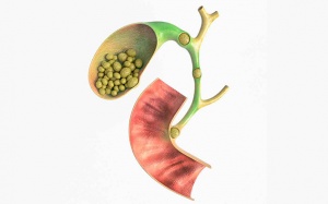 Những điều bạn cần biết về sỏi mật 16mm