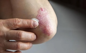 Cẩn trọng trong việc chọn thuốc điều trị bệnh vảy nến