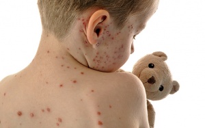 WHO cảnh báo bệnh sởi sắp là mối đe dọa toàn cầu