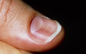 Làm sao để móng tay tôi không bị cong và gãy?