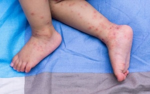 Cách xử trí khi trẻ mắc bệnh tay chân miệng