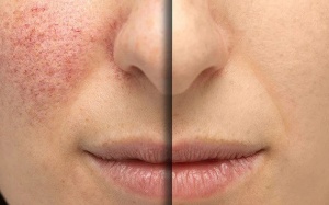 Những điều cần tránh khi bị chứng đỏ mặt rosacea