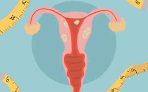 5 biến chứng thường gặp của bệnh u xơ tử cung