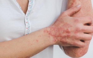 Cách chữa vảy nến hiệu quả không phải ai cũng biết