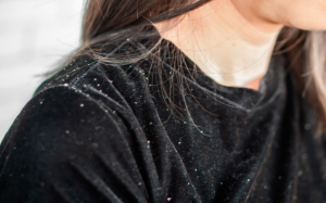 Tại sao nhiều gàu vào mùa Đông và cách cải thiện?