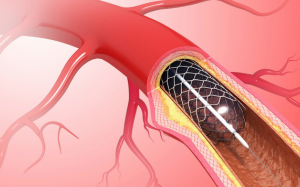 Đặt stent động mạch vành cần lưu ý những gì?