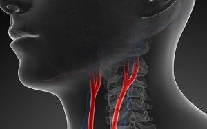 Hẹp động mạch cảnh và những điều bạn cần biết