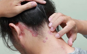 Mách bạn cách cải thiện bệnh vảy nến da đầu hiệu quả