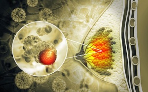 Sưng đau vú, vào viện phát hiện ung thư vú thể viêm hiếm gặp