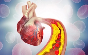 Những điều cần biết về xơ vữa động mạch vành