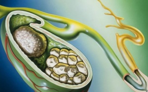 Sỏi mật 43mm điều trị thế nào, có dùng TPBVSK Kim Đởm Khang được không?