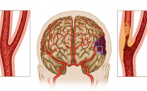 Chẩn đoán hẹp động mạch cảnh thế nào?
