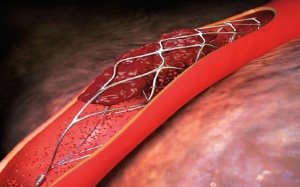 Đặt stent động mạch vành diễn ra thế nào?