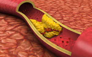 Người mỡ máu cao phòng xơ vữa động mạch thế nào?