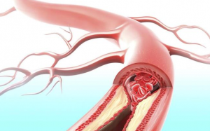 Người mắc bệnh tim mạch phòng nguy cơ xơ vữa động mạch thế nào? 