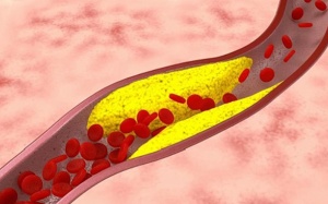 Những điều bạn cần biết về xơ vữa động mạch vành