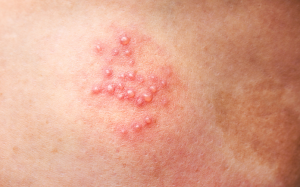 Mẹo đơn giản hỗ trợ chữa zona thần kinh tại nhà