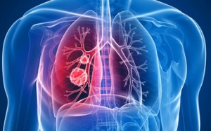 Dấu hiệu phát hiện sớm ung thư phổi di căn hạch trung thất