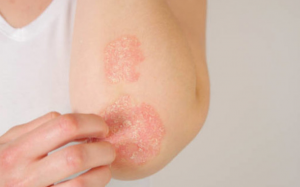 Cách phòng ngừa tái phát bệnh vảy nến khi vào mùa Đông