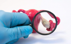 Buồng trứng đa nang liên quan thế nào tới bệnh trầm cảm?