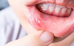 Cách tốt nhất để giảm đau loét miệng là gì?