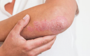 Nguyên nhân gây bệnh vẩy nến và cách chữa hiệu quả tại nhà