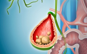 Sỏi túi mật 25mm nên điều trị như thế nào?