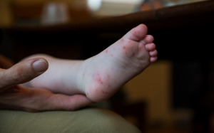 4 cách cải thiện chân tay miệng tại nhà