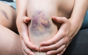 9 dấu hiệu có thể cảnh báo gan đang tổn thương