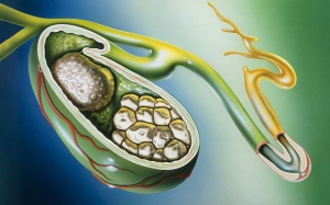 Đám sỏi mật 8,5mm nên chữa trị thế nào?